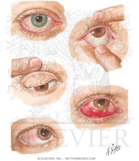 Watermarked preview of unlabeled image: Eyelid Infection and Conjunctival Disorders