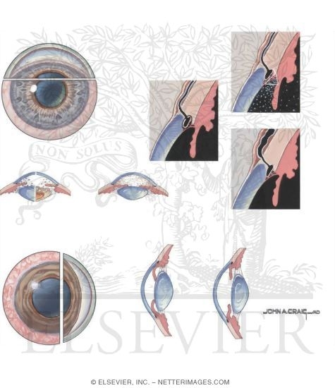 Watermarked preview of unlabeled image: Glaucoma