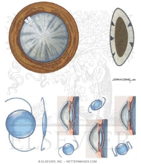 Watermarked preview of unlabeled image: Cataract