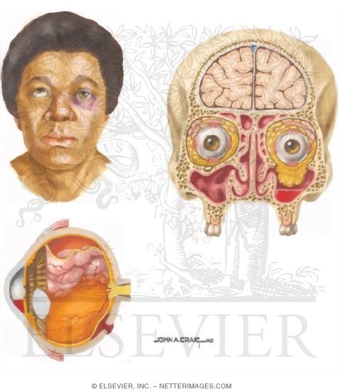 Watermarked preview of unlabeled image: Clinical Findings In Orbital Blow-Out Fracture