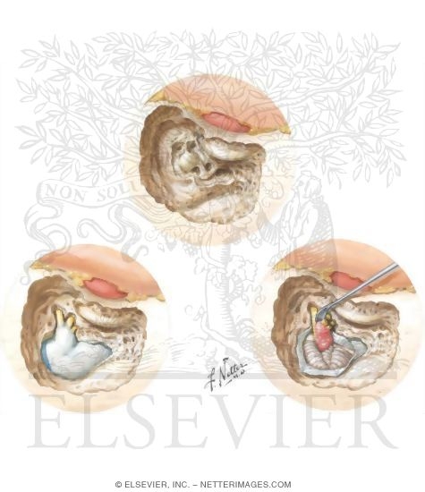 Watermarked preview of unlabeled image: Translabyrinthine Removal of Acoustic Neuroma