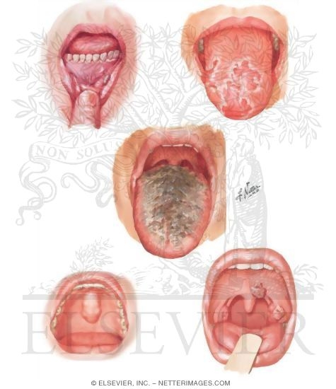Watermarked preview of unlabeled image: Common Oral Lesions