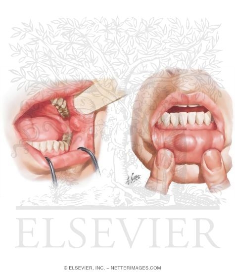 Watermarked preview of unlabeled image: Common Oral Lesions