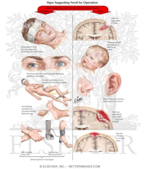 Watermarked preview of labeled image: Signs Suggesting Need for Operation In Head Injuries