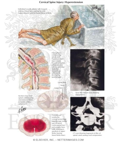 Paralysis Without Vertebral Injury