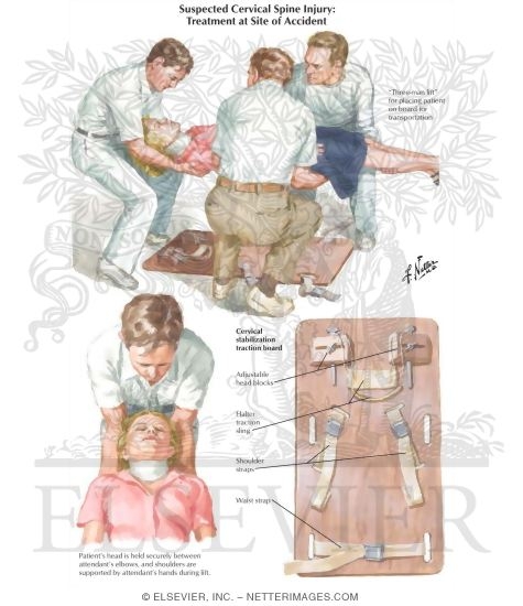 Watermarked preview of labeled image: Suspected Cervical Spine Injury: Treatment At Site of Accident