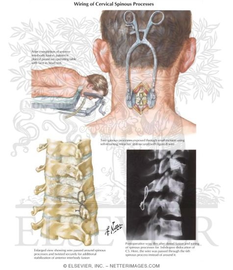 Wiring of Cervical Spinous Processes
