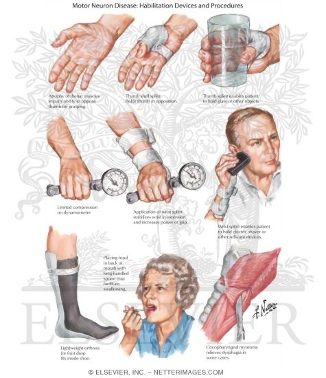 Watermarked preview of labeled image: Motor Neuron Disease: Habilitation Devices and Procedures
