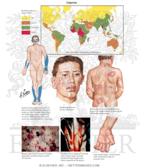 Watermarked preview of labeled image: Leprosy
