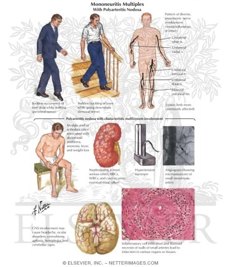 Mononeuritis Multiplex with Polyarteritis Nodosa