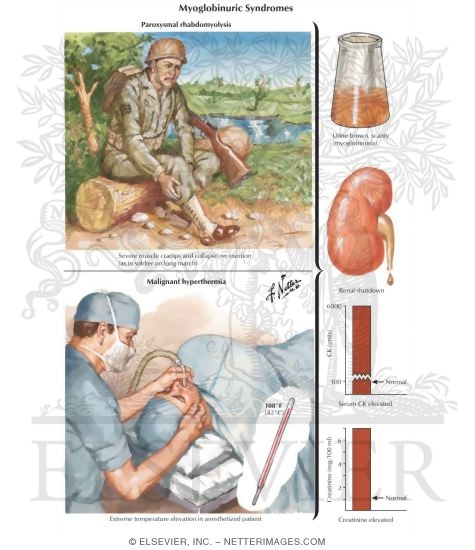 Watermarked preview of labeled image: Myoglobinuric Syndromes