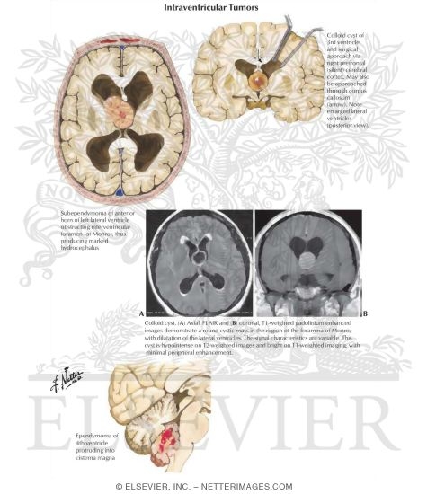 Watermarked preview of labeled image: Intraventricular Tumors