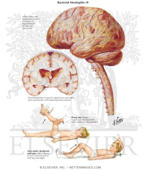 Watermarked preview of labeled image: Bacterial Meningitis