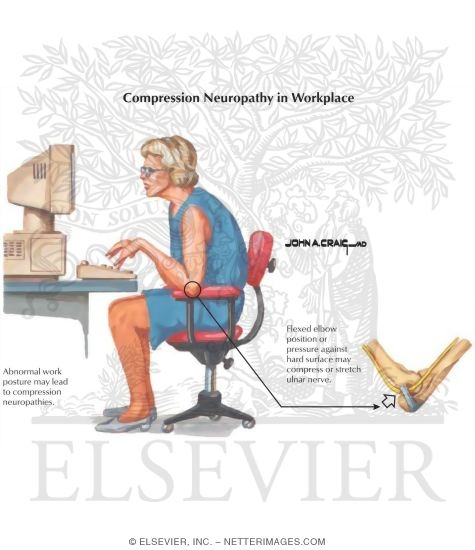 Watermarked preview of labeled image: Compression Neuropathy In Workplace