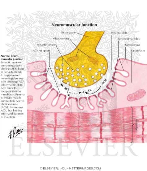 Watermarked preview of labeled image: Myasthenia Gravis