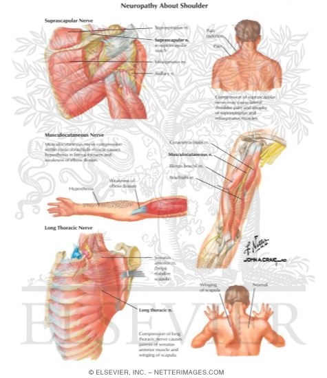 Watermarked preview of labeled image: Neuropathy About Shoulder