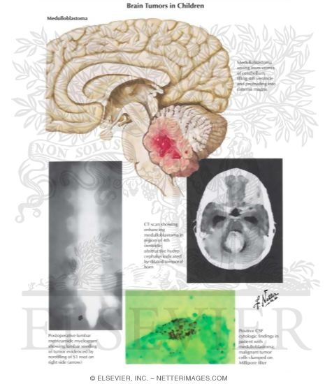 Brain Tumors In Children