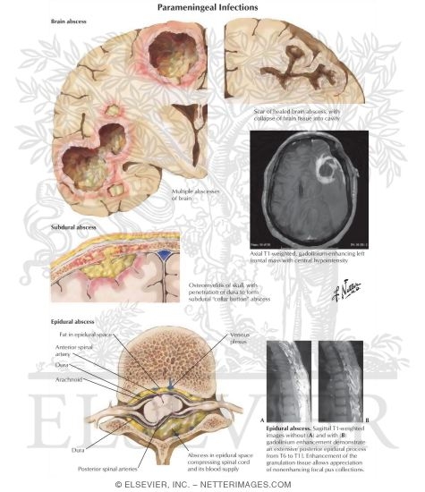 Parameningeal Infections