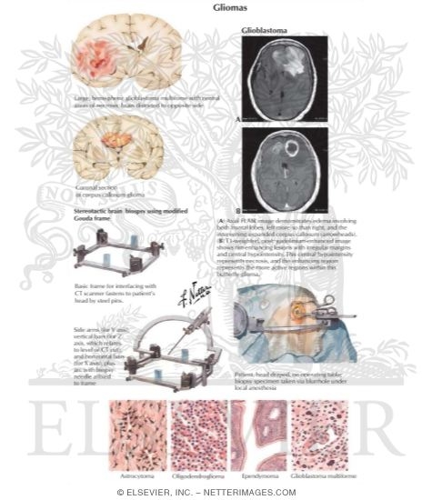 Gliomas
