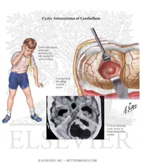 Watermarked preview of labeled image: Cystic Astrocytoma of Cerebellum