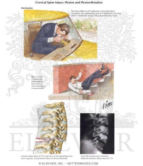 Cervical Spine Injury: Flexion and Flexion-Rotation