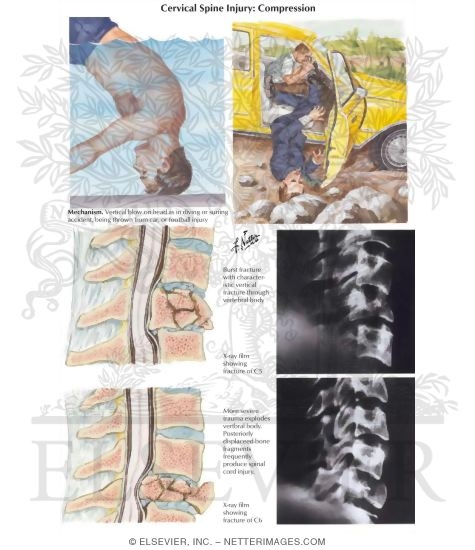 Watermarked preview of labeled image: Cervical Spine Injury: Compression