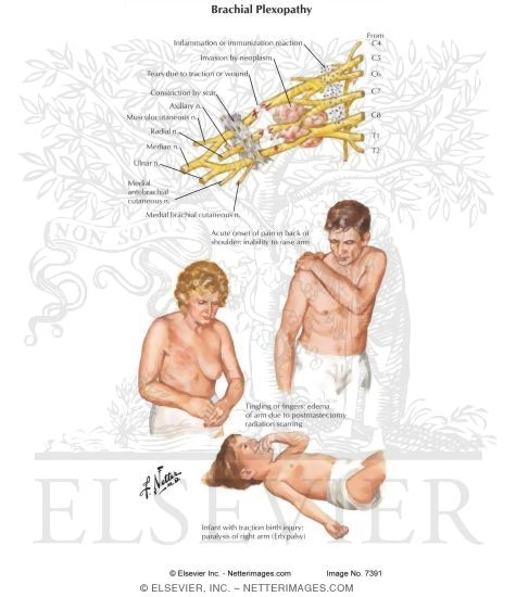 Watermarked preview of labeled image: Brachial Plexopathy
