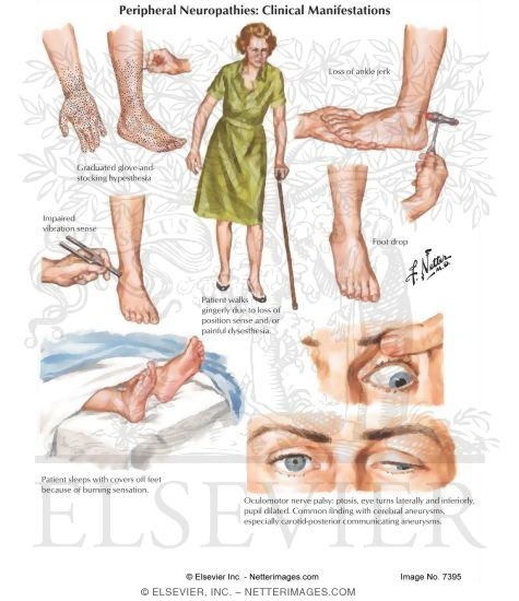 Peripheral Neuropathies: Clinical Manifestations