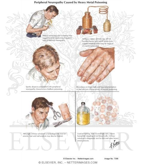 Watermarked preview of labeled image: Peripheral Neuropathy Caused By Heavy Metal Poisoning