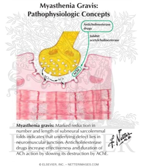 Myasthenia Gravis: Pathophysiologic Concepts