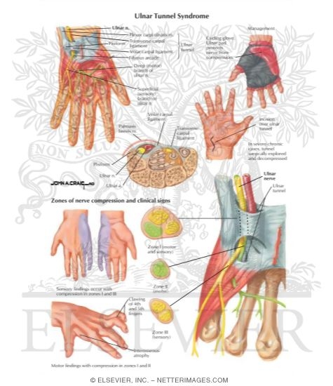 Watermarked preview of labeled image: Ulnar Tunnel Syndrome