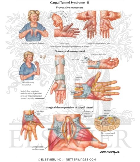 Watermarked preview of labeled image: Carpal Tunnel Syndrome
