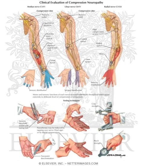Watermarked preview of labeled image: Clinical Evaluation of Compression Neuropathy