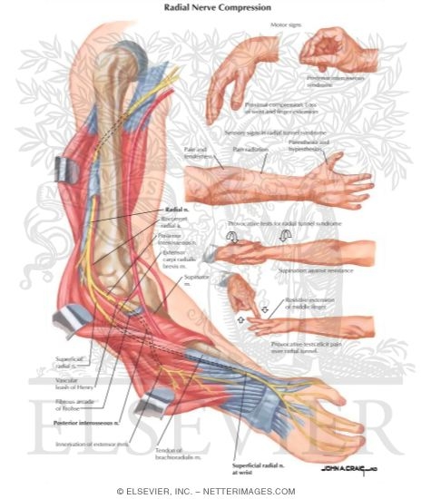 Watermarked preview of labeled image: Radial Nerve Compression