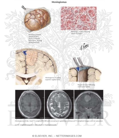 Watermarked preview of labeled image: Meningiomas