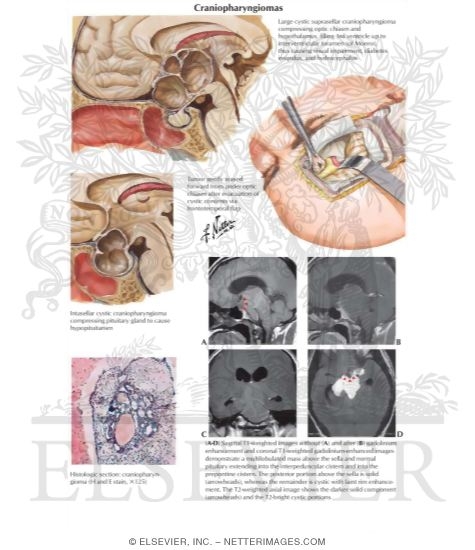 Watermarked preview of labeled image: Craniopharyngiomas