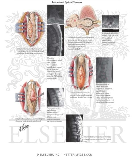 Watermarked preview of labeled image: Intradural Spinal Tumors