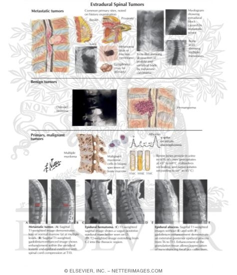 Watermarked preview of labeled image: Extradural Spinal Tumors
