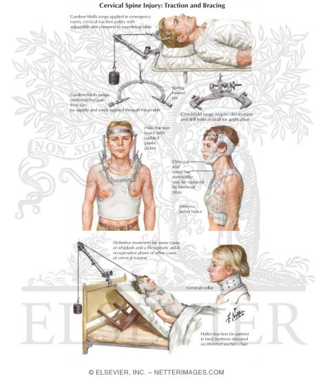 Cervical Spine Injury: Traction and Bracing