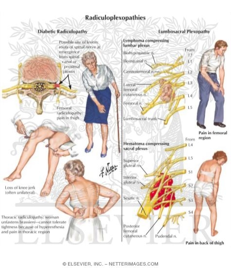 Watermarked preview of labeled image: Radiculoplexopathies