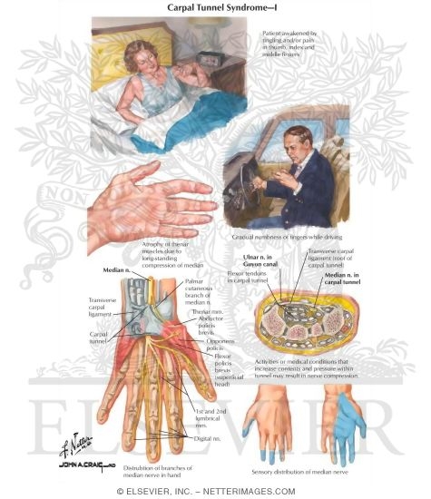 Watermarked preview of labeled image: Carpal Tunnel Syndrome