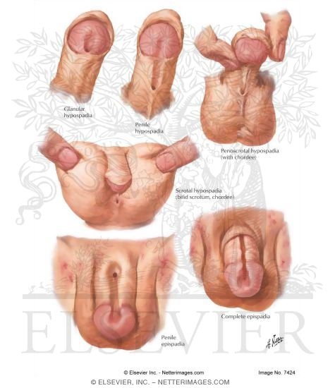 Hypospadia, Epispadia