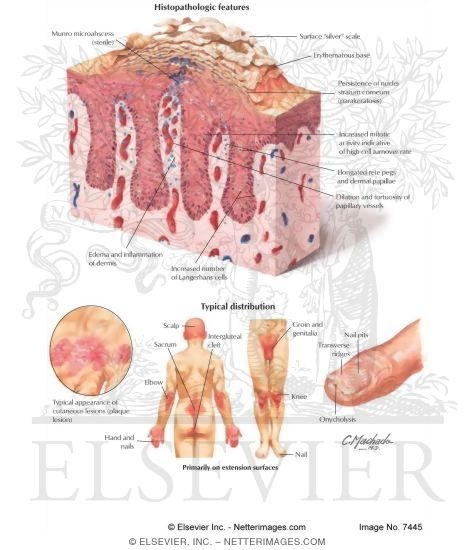 Watermarked preview of labeled image: Psoriasis: Clinical Correlation