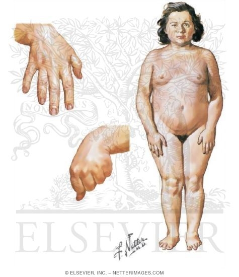 Albright's Hereditary Osteodystrophy