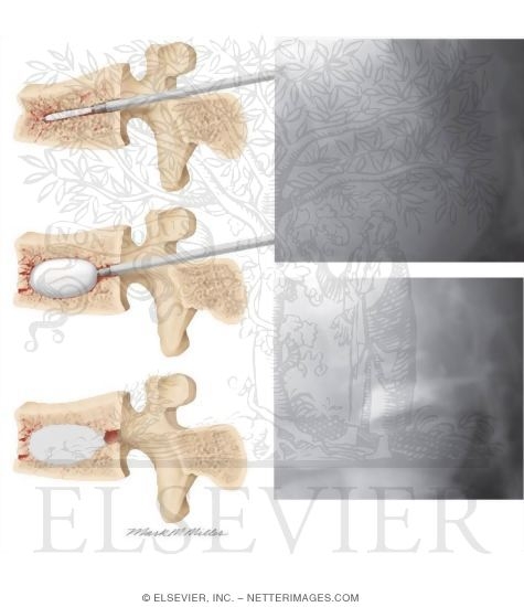 Watermarked preview of unlabeled image: Kyphoplasty: Pretreatment and Posttreatment Radiographs