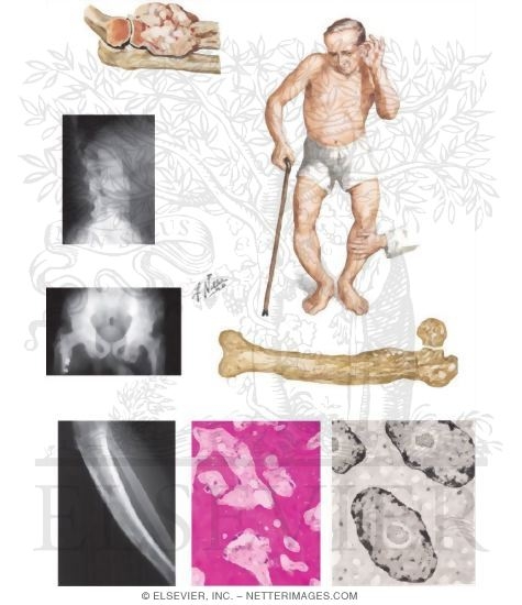Paget Disease
