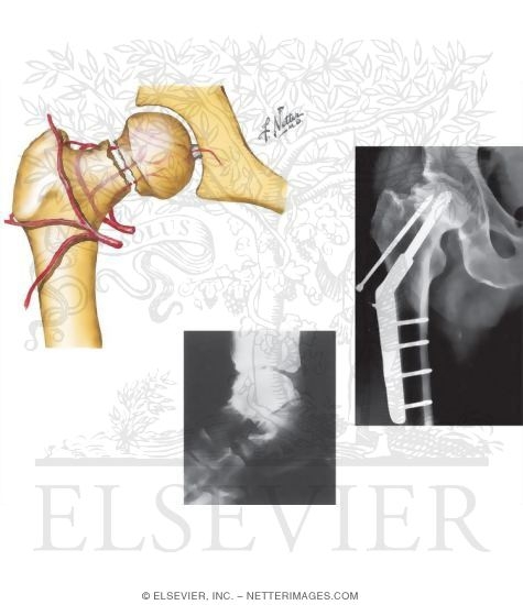 Watermarked preview of unlabeled image: Osteonecrosis After Fracture