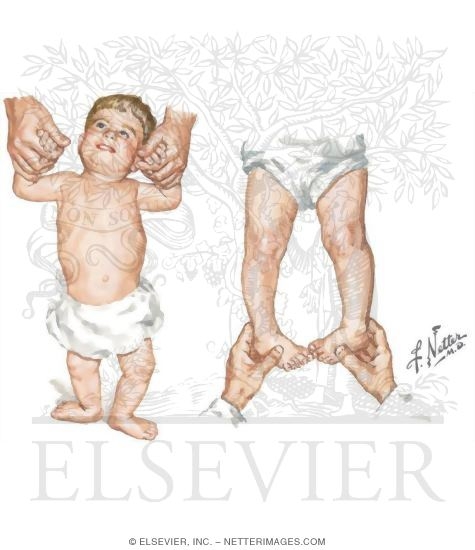 Watermarked preview of unlabeled image: External Rotation of Hips
Rotational Deformities of Lower Limb: Toeing-Out