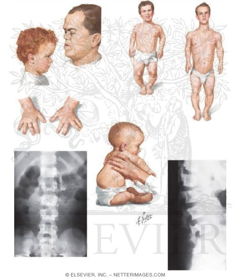 Achondroplasia