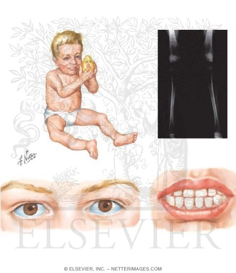 Type I Osteogenesis Imperfecta